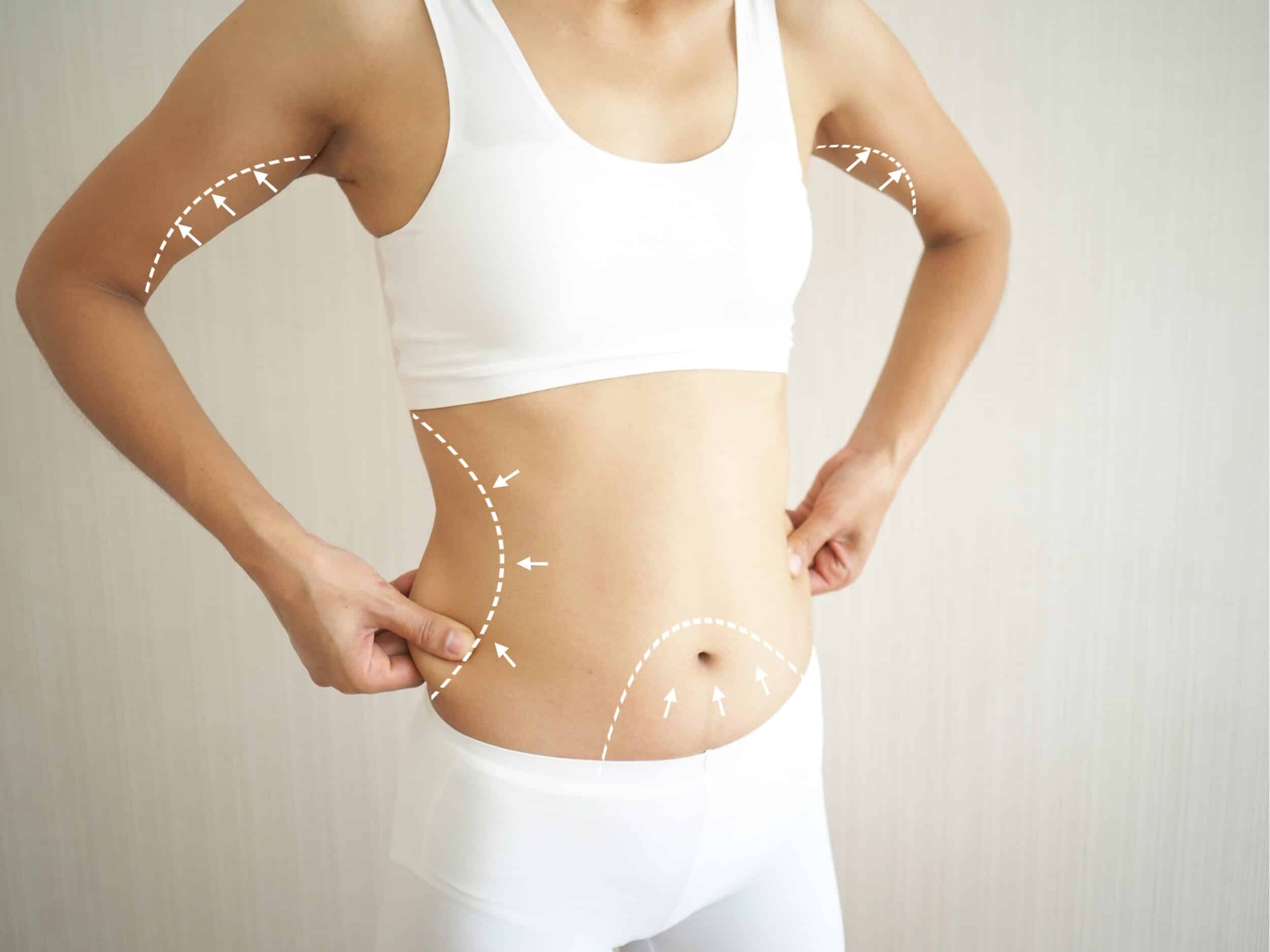 Belt Lipectomy vs. Tummy Tuck