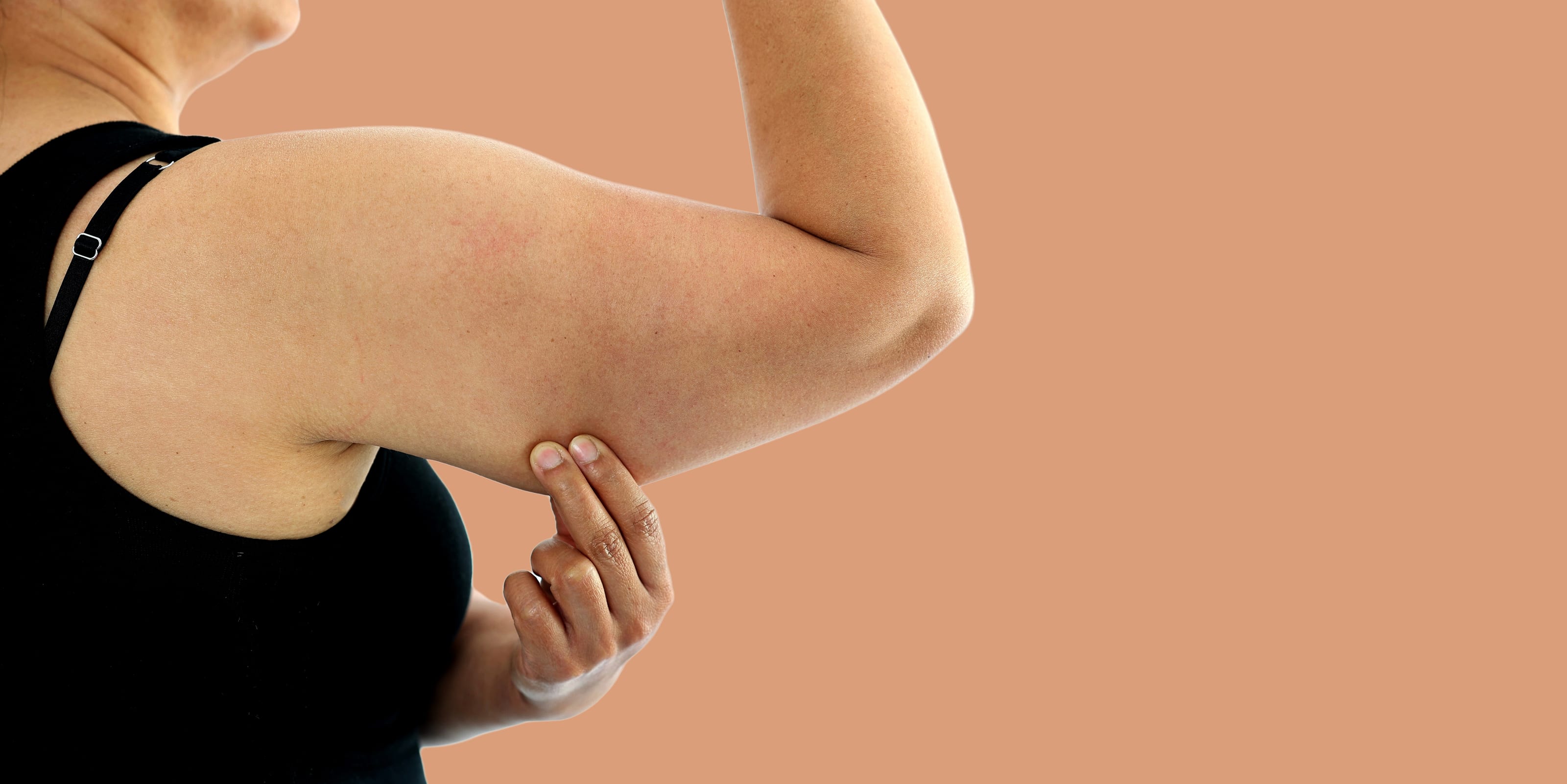 Bye-Bye Bat Wings: How Brachioplasty Can Tone Your Arms