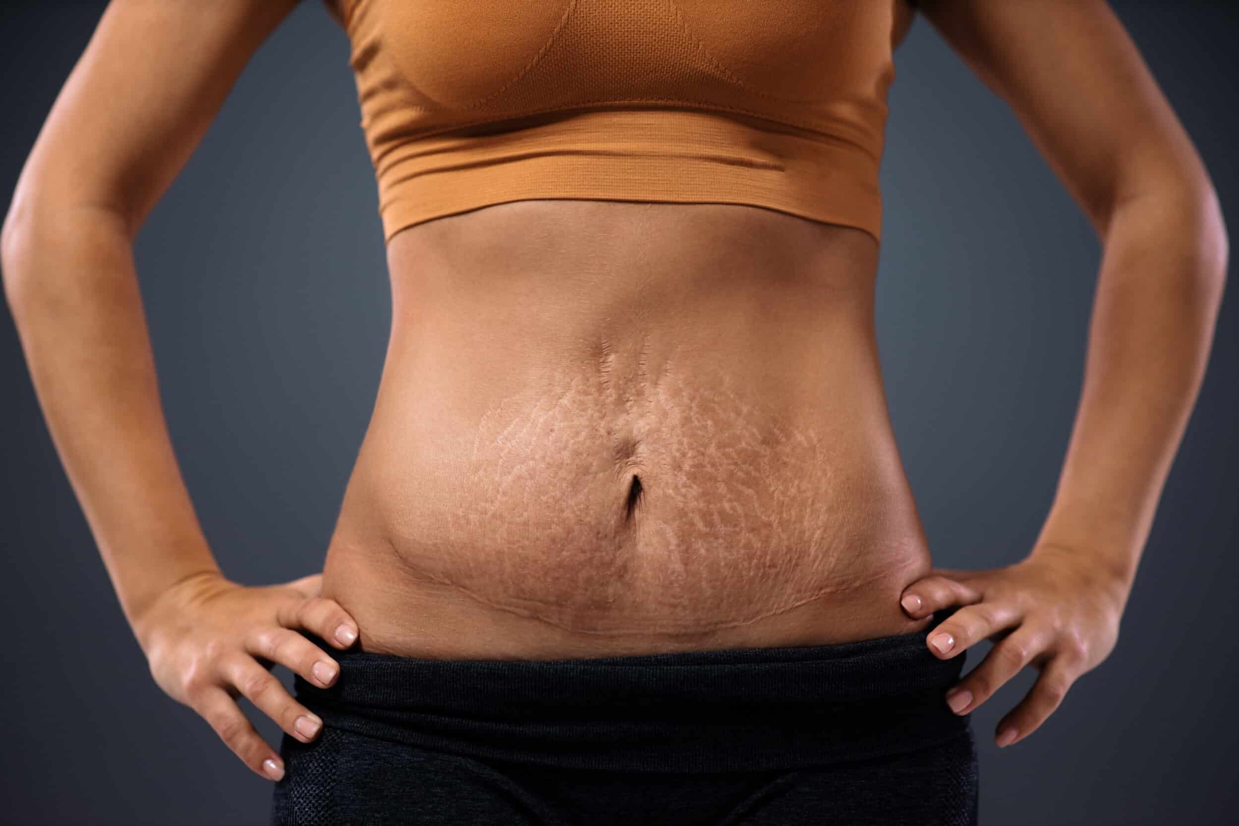 How Plastic Surgery Can Help You Achieve Your Post-Pregnancy Body Goals