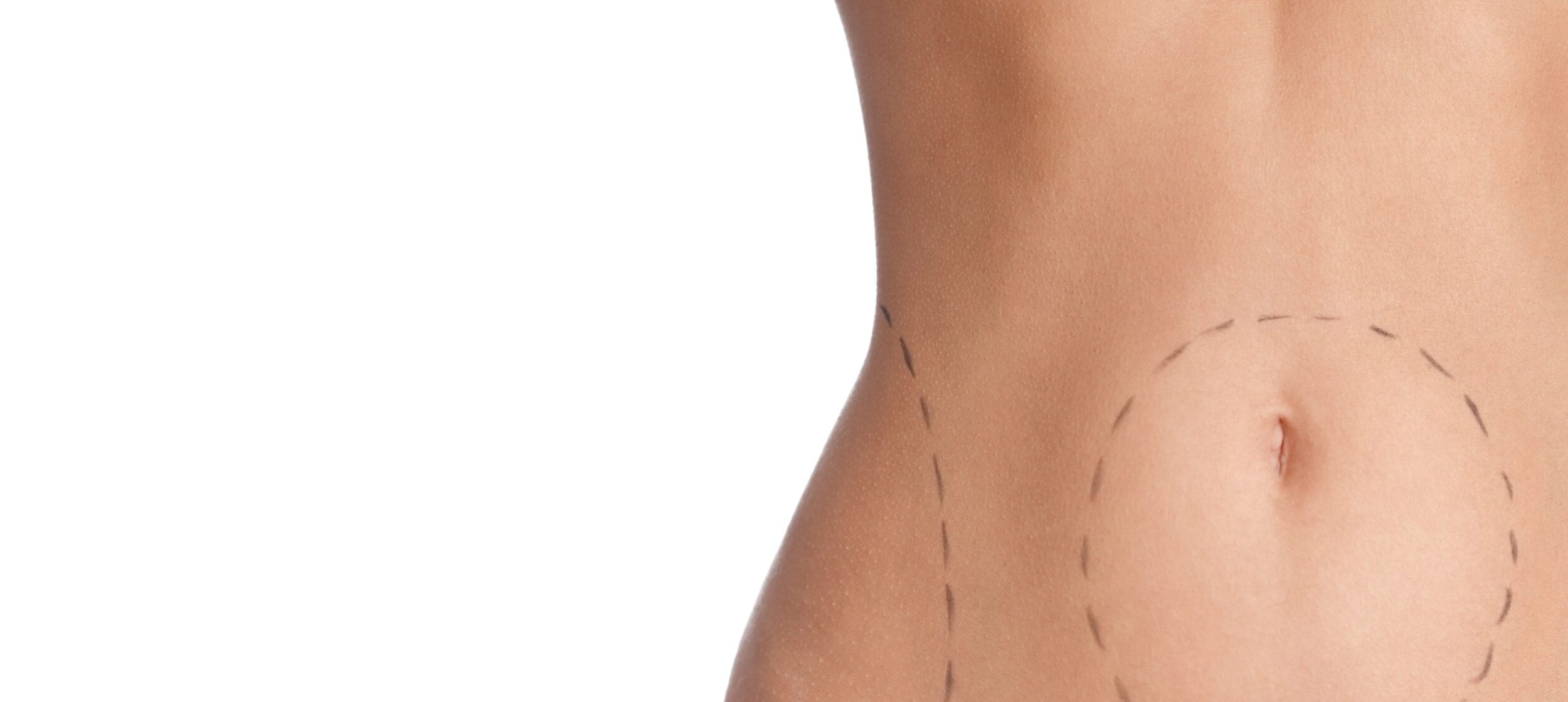 The Difference Between Liposuction and Smartlipo™