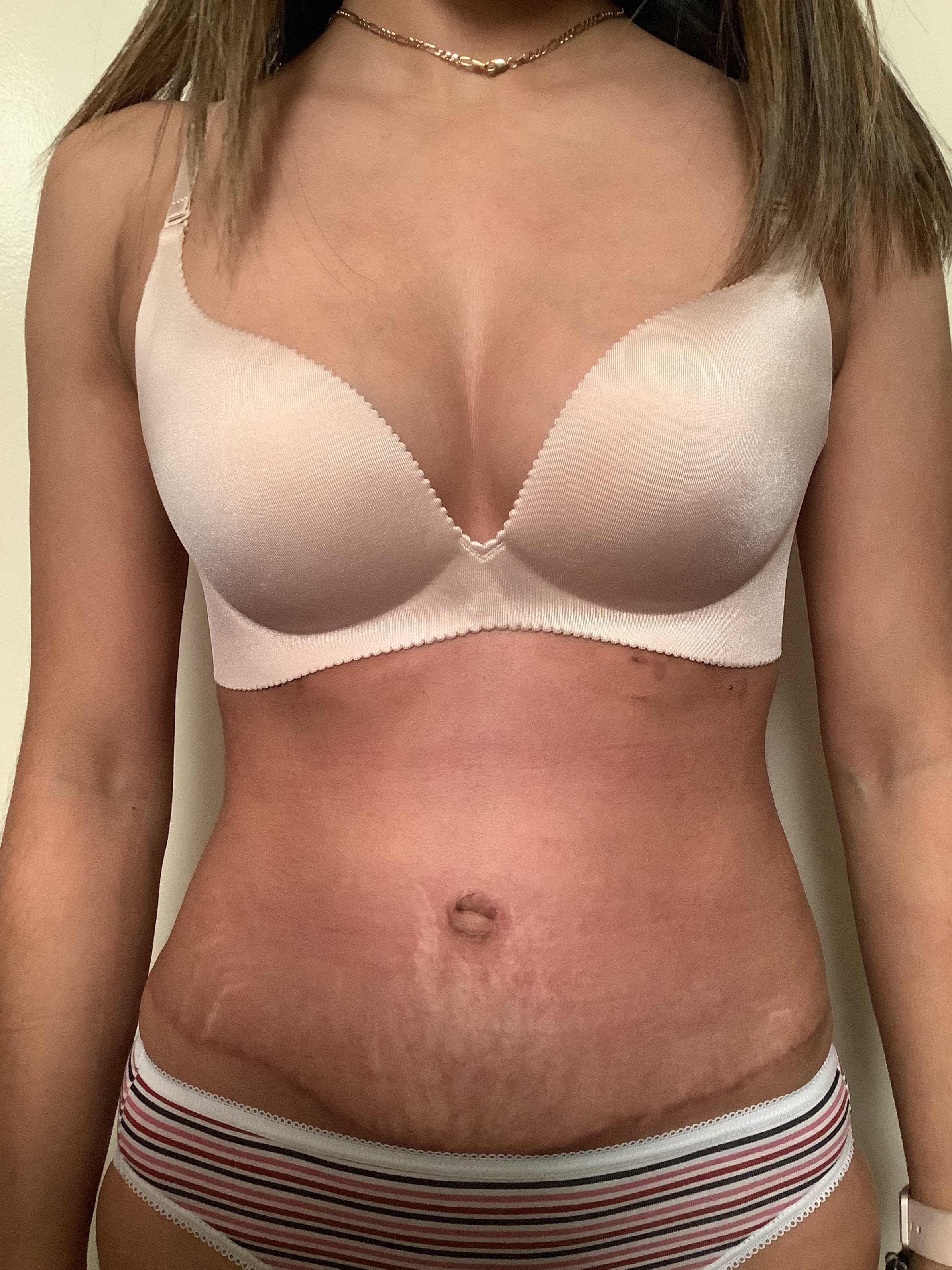 After Image: Abdominoplasty - front