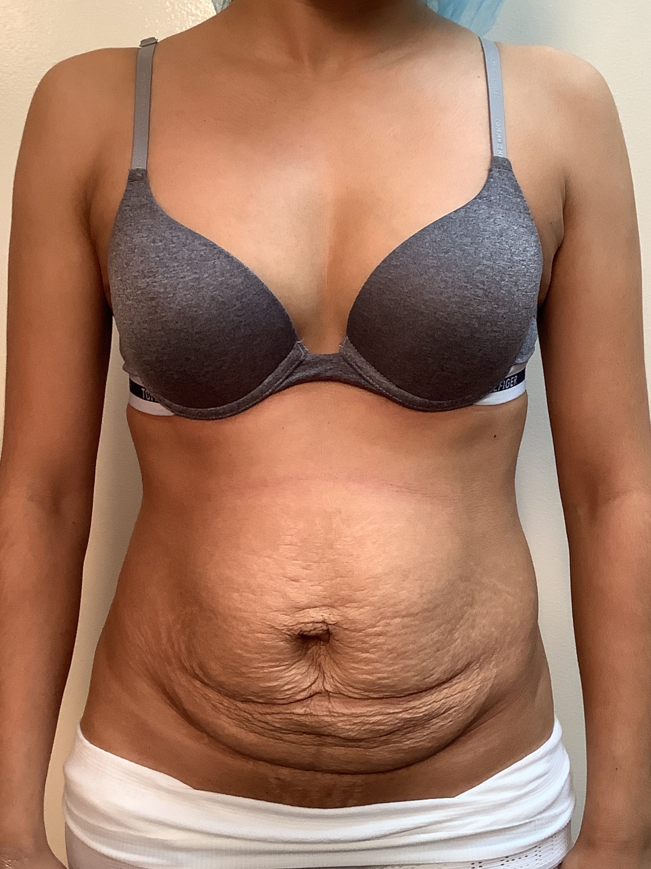 Before Image: Abdominoplasty - front