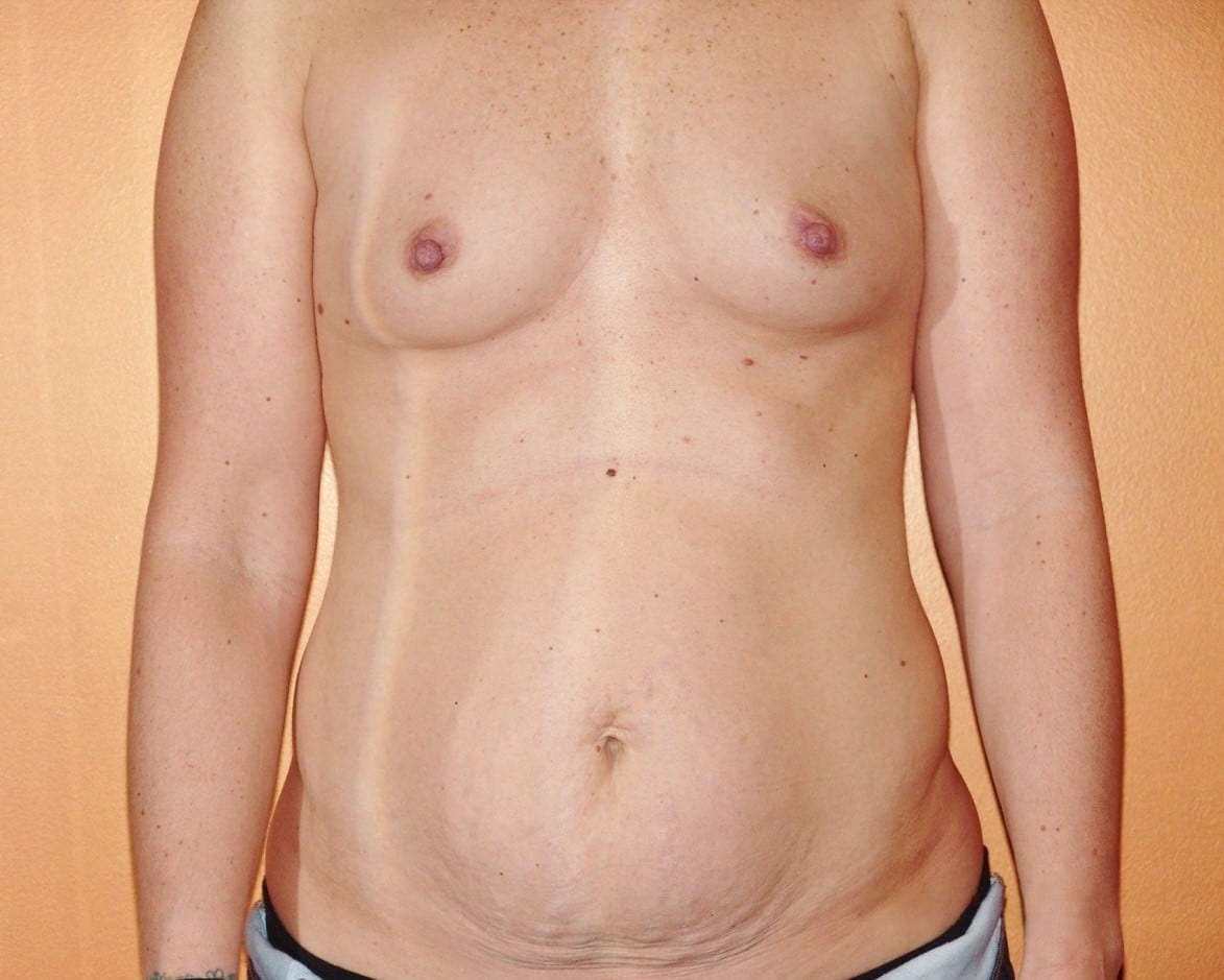 Before Image: Mommy Makeover - front
