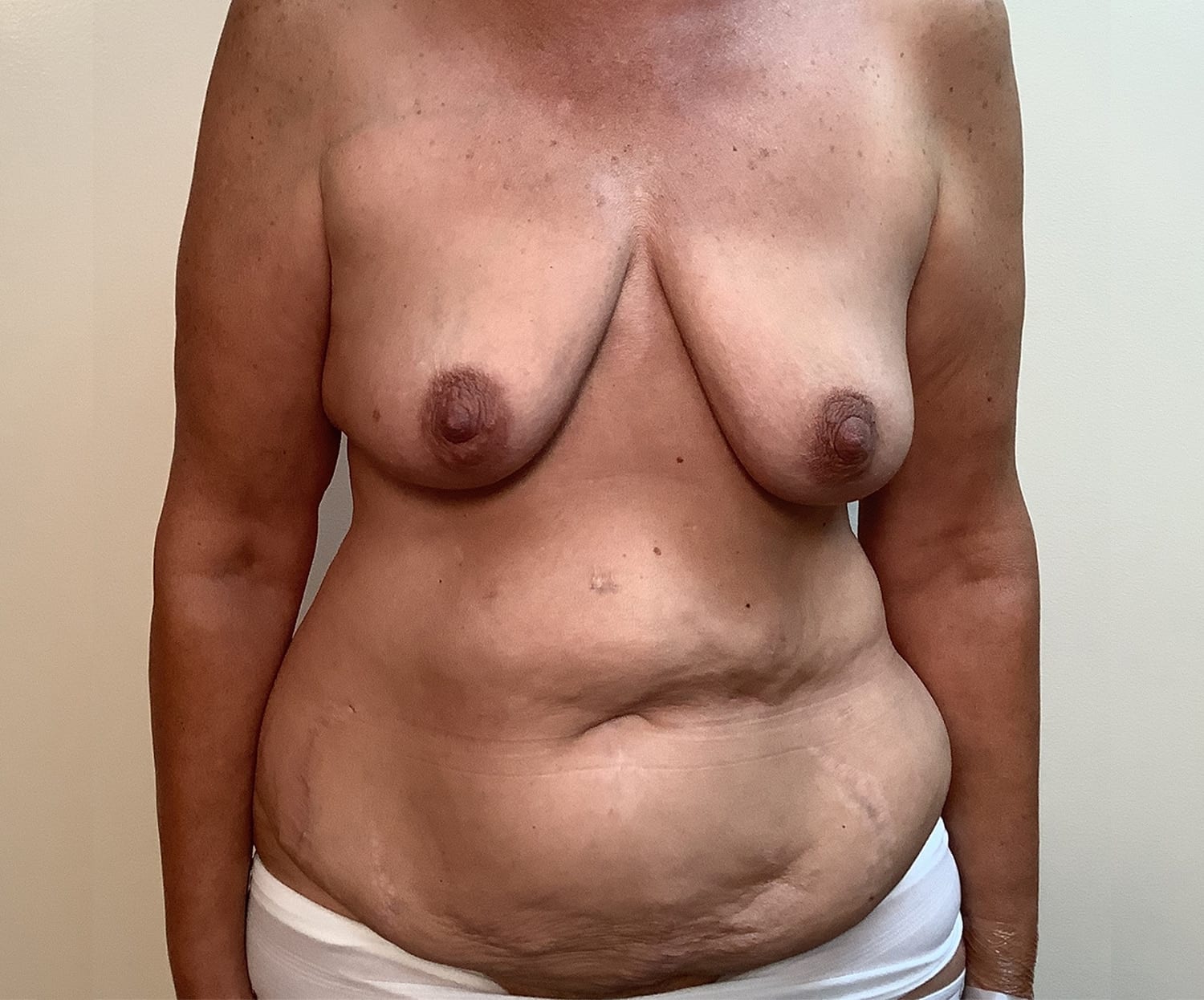 Before Image: After Major Weight Loss - front