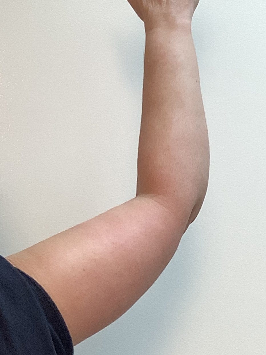 After Image: Brachioplasty - other
