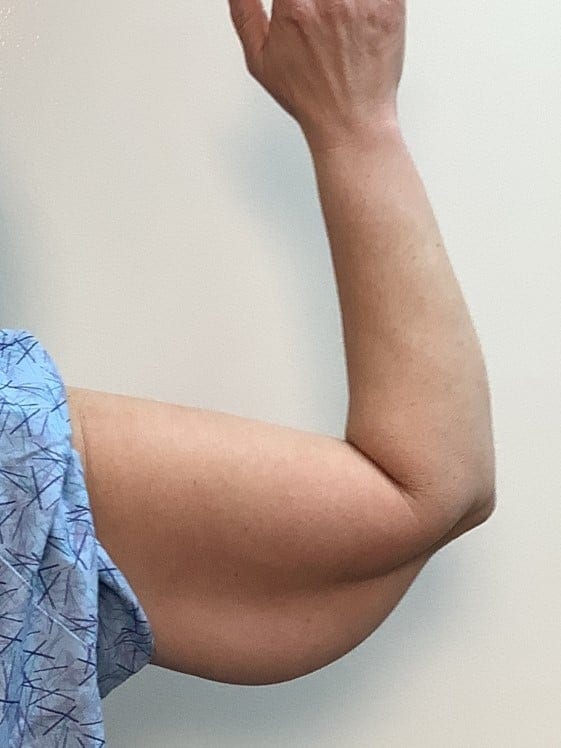 Before Image: Brachioplasty - other