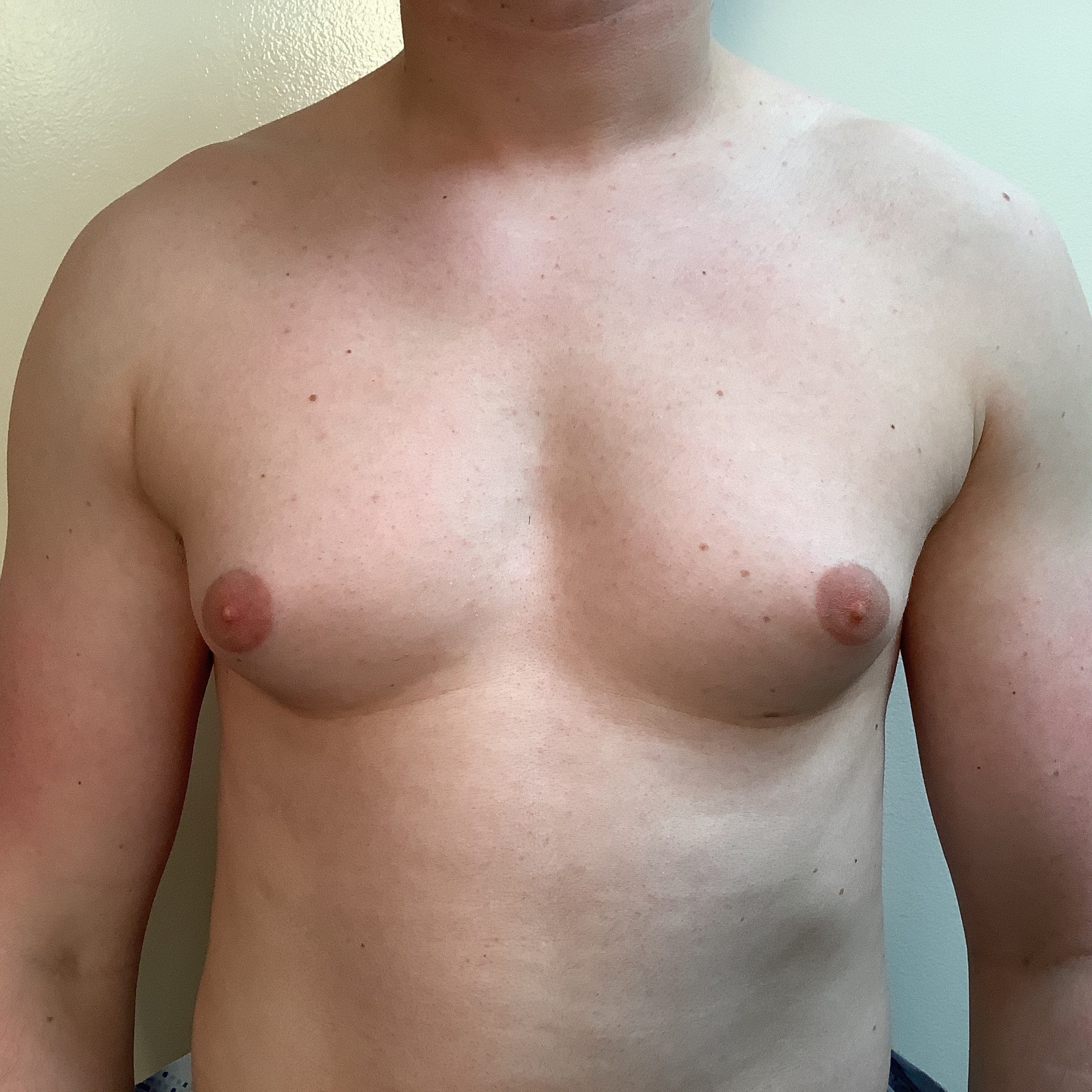 Before Image: Gynecomastia - front