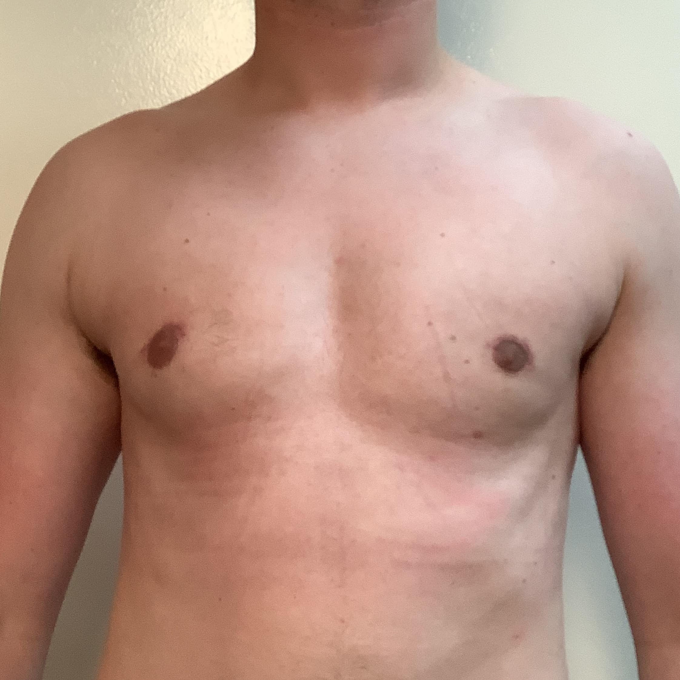 After Image: Gynecomastia - front