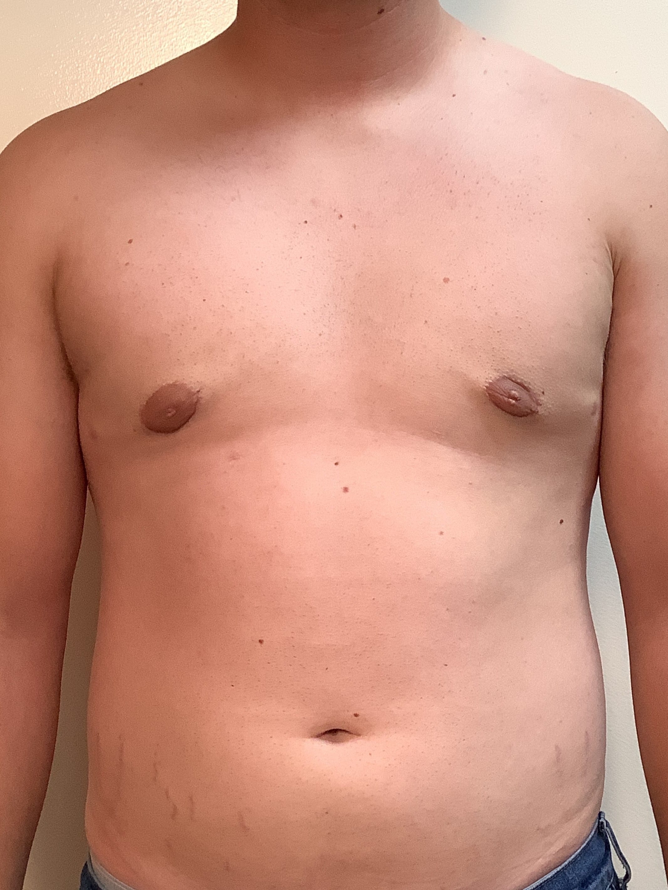 After Image: Gynecomastia - front