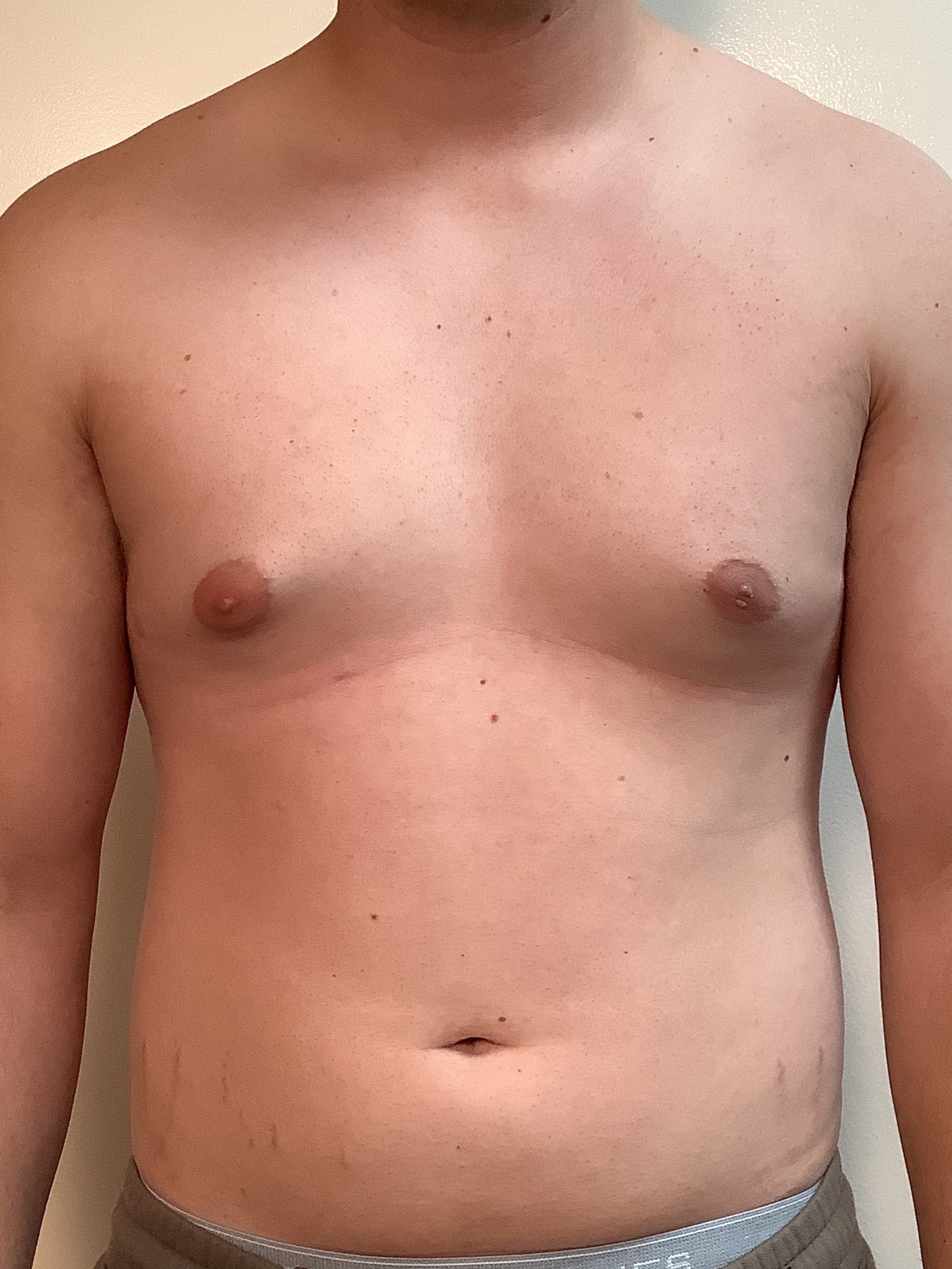 Before Image: Gynecomastia - front
