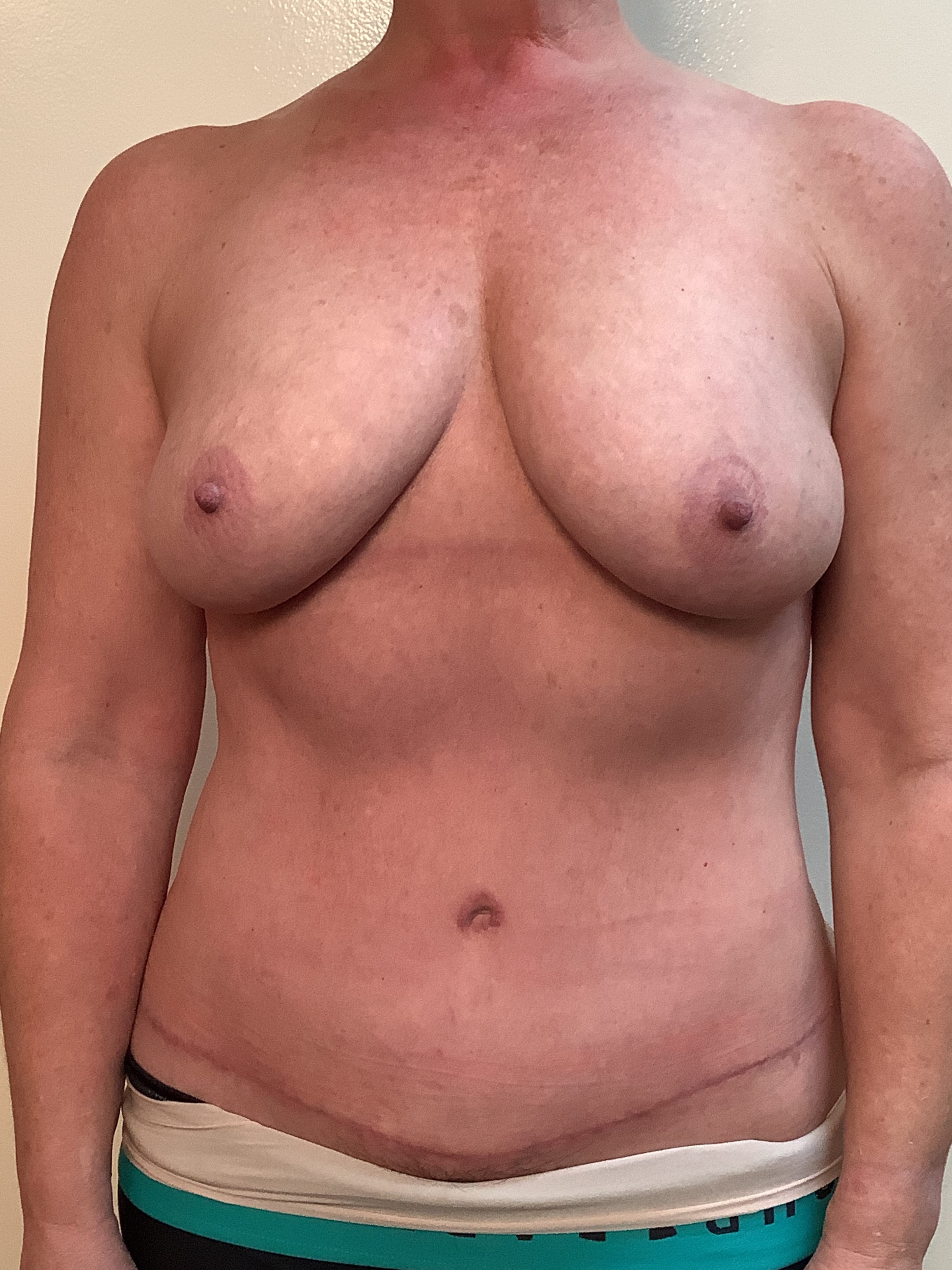 After Image: Fat Grafting to Breasts - front