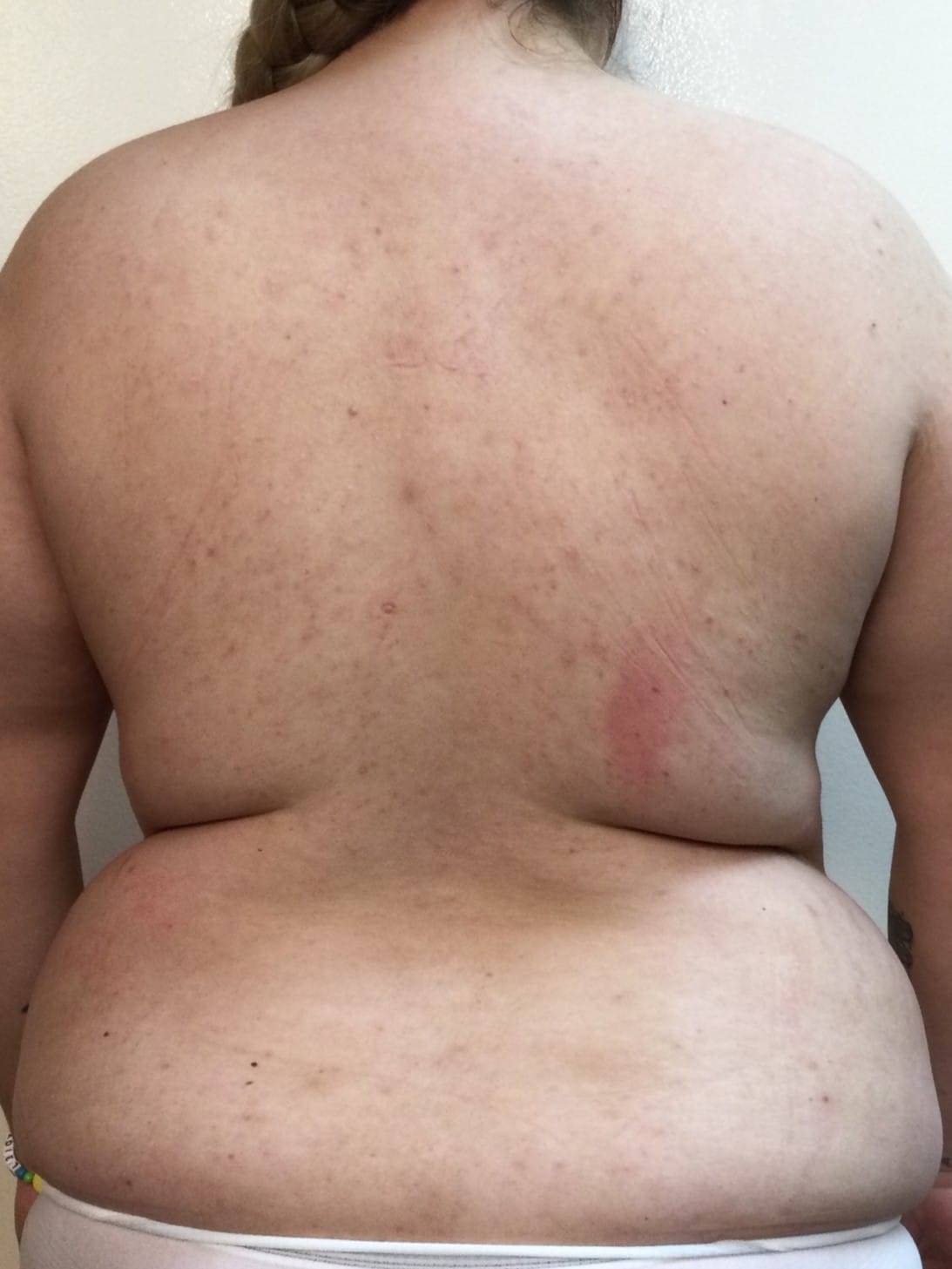 Before Image: Liposuction - back