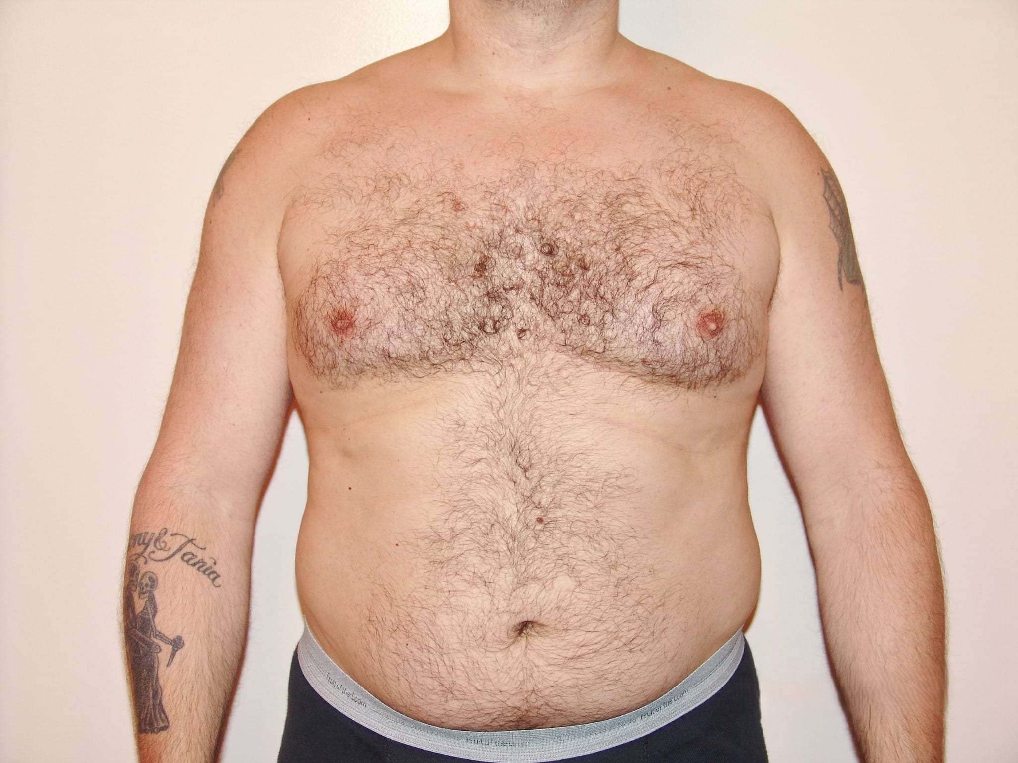 Before Image: Liposuction - front