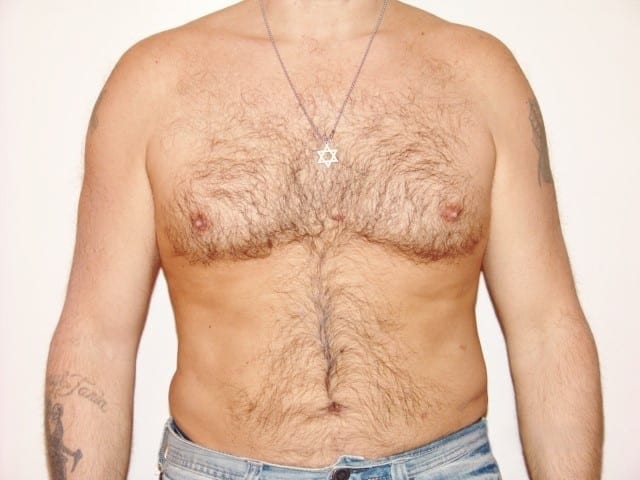 After Image: Liposuction - front