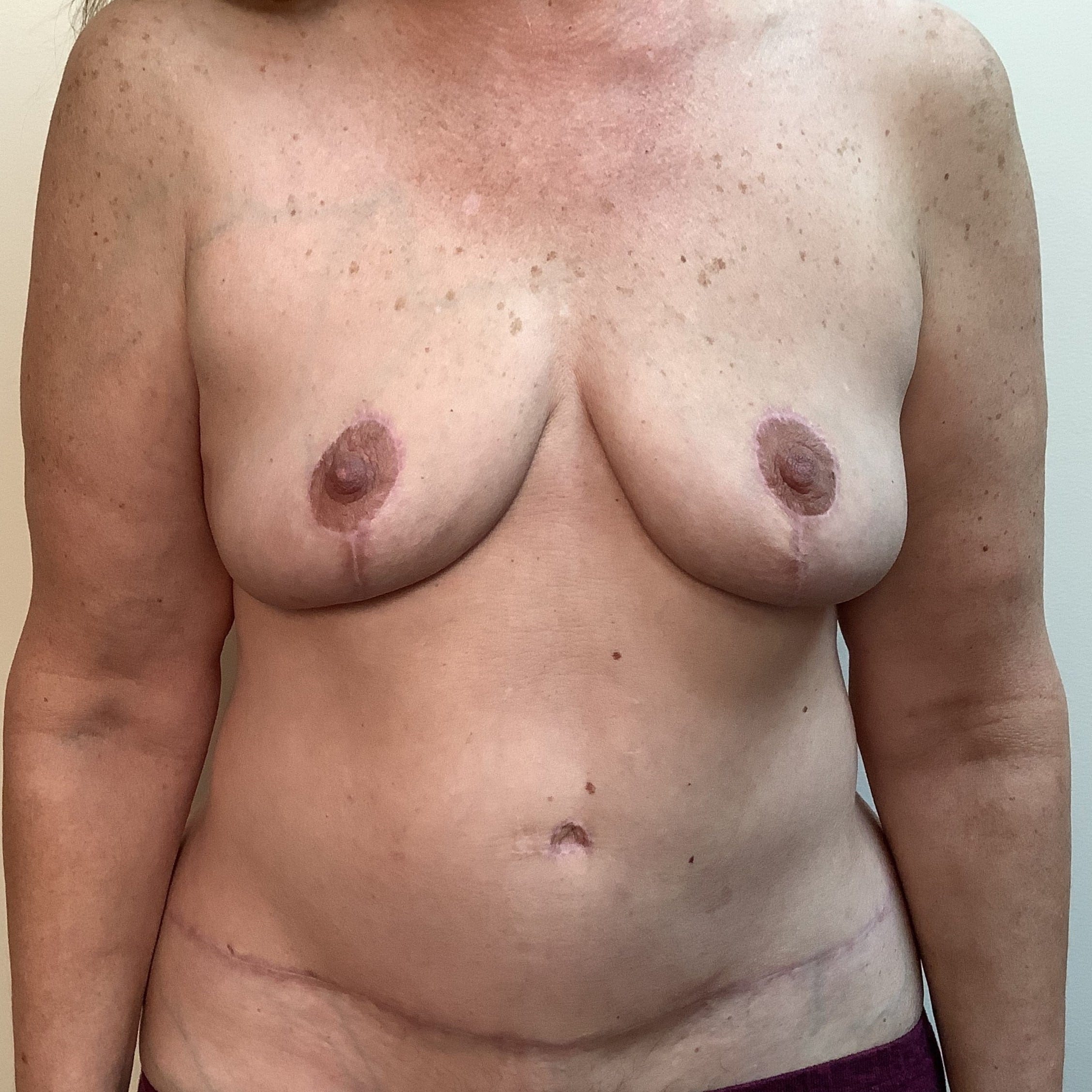 After Image: Mommy Makeover - front