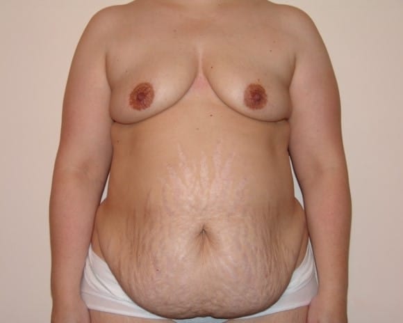 Before Image: Mommy Makeover - front