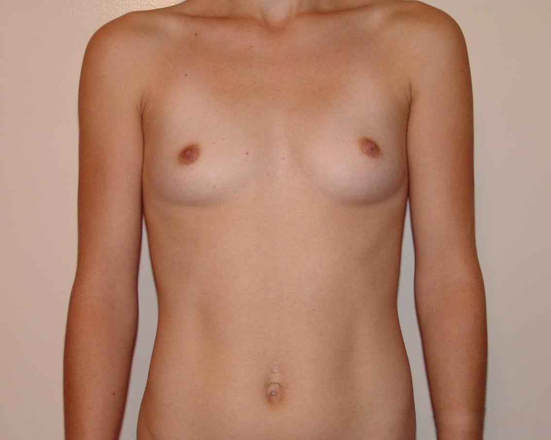 Before Image: Breast Augmentation - front
