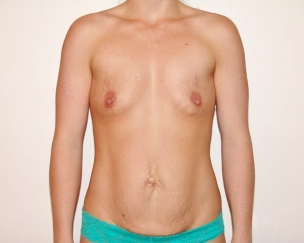 Before Image: Breast Augmentation - front