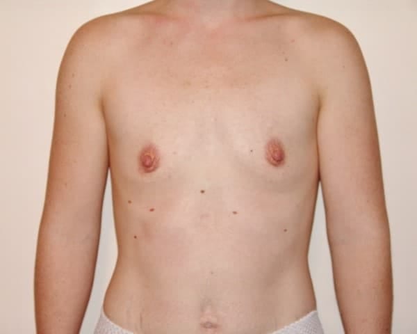 Before Image: Breast Augmentation - front