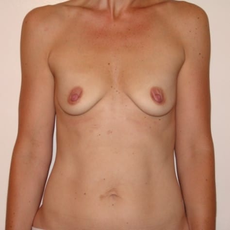 Before Image: Breast Augmentation - front