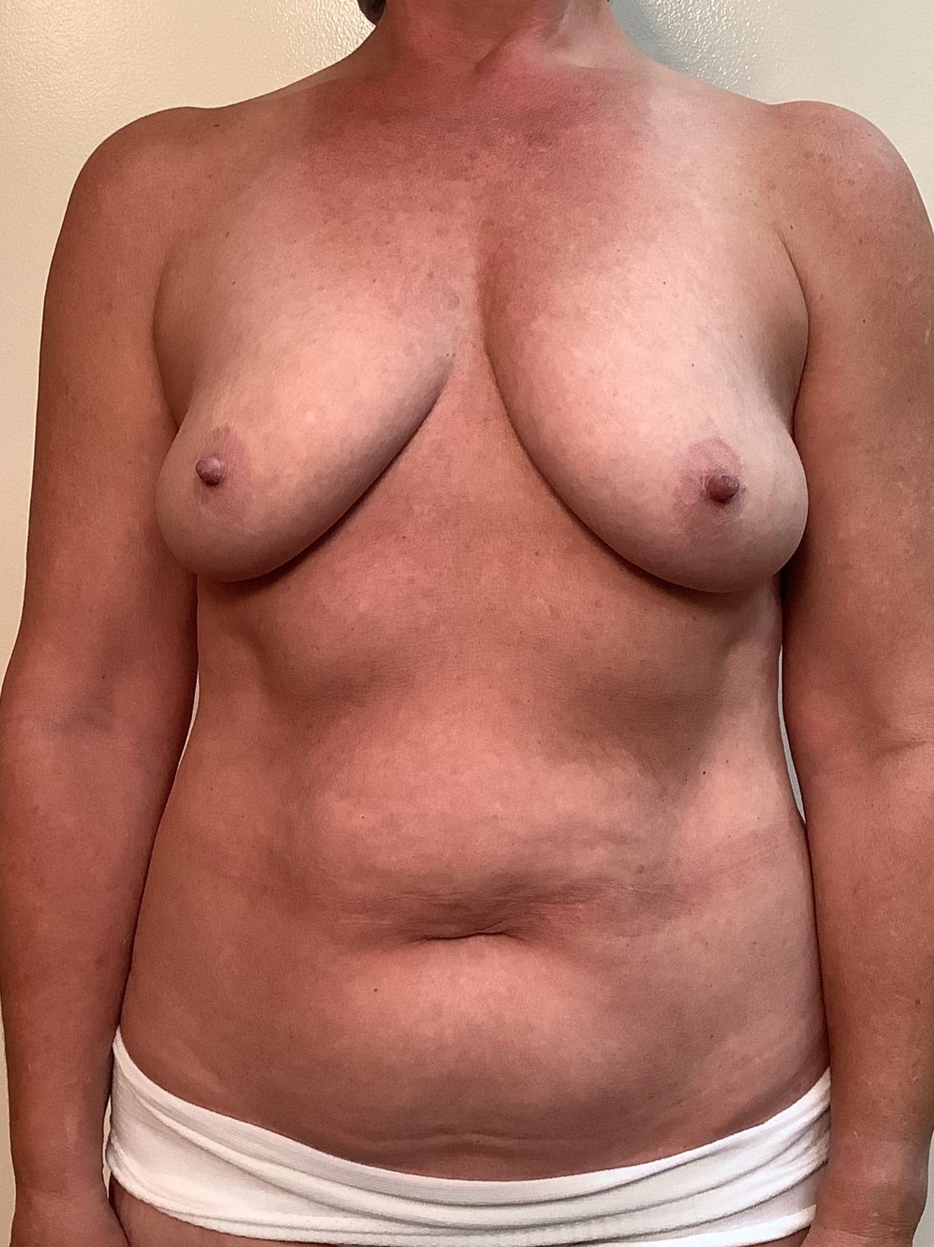 Before Image: Fat Grafting to Breasts - front