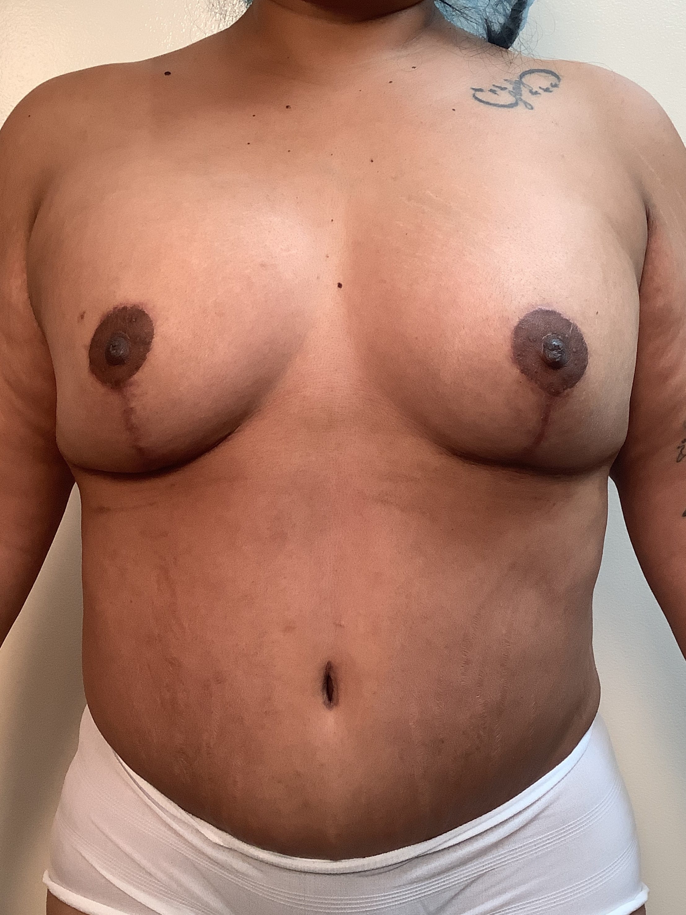 Before Image: Implant Exchange - front